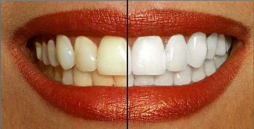 Alimentos que blanquearán tus dientes naturalmente en semanas 